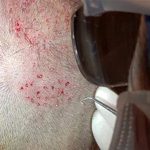 Img-expertos-en-microimplante-capilar-Paso_a_Paso-2