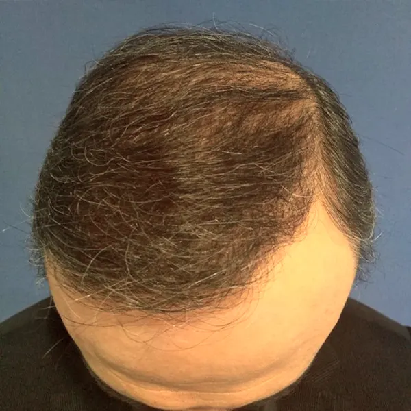 img-implante-capilar-medellin-1