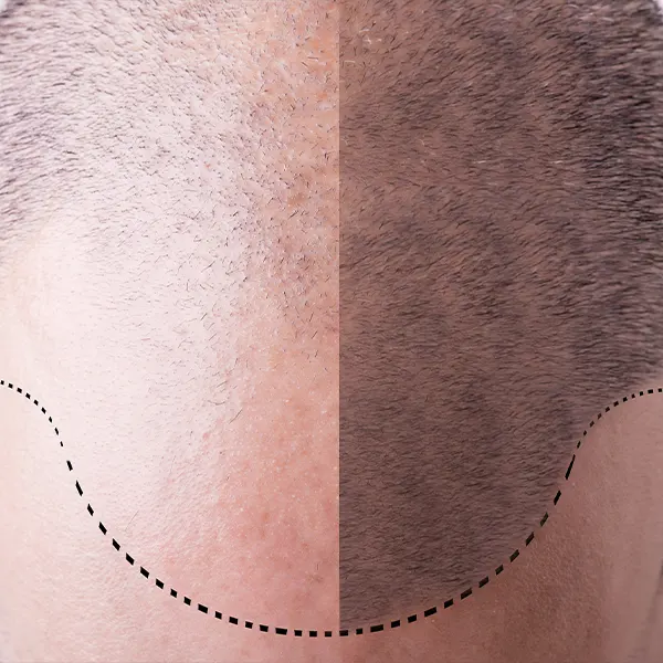 img-restauracion-capilar-1