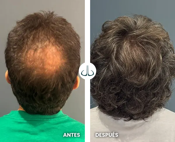 Img-MicroimplanteJDL-Antes&Despues-implante-capilar-medellin-17 Img-MicroimplanteJDL-Antes&Despues-implante-capilar-medellin-17