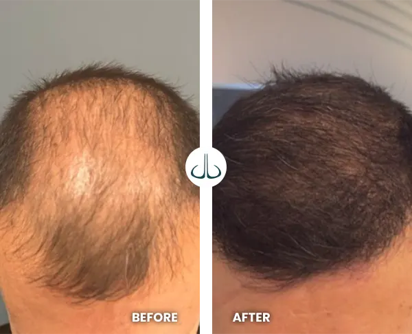 Img-MicroimplanteJDL-Before&After-Hair-implant-specialist-in-Colombia-18 Img-MicroimplanteJDL-Before&After-Hair-implant-specialist-in-Colombia-18