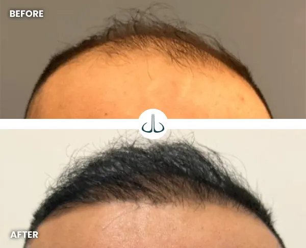 Img-MicroimplanteJDL-Before&After-Hair-implant-specialist-in-Colombia-19 Img-MicroimplanteJDL-Before&After-Hair-implant-specialist-in-Colombia-19